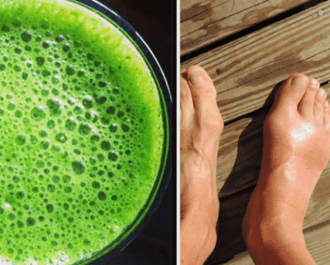 How to Treat Uric Acid Crystallization in Joints for Gout and Joint Pain