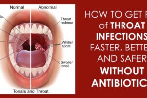 12 Effective Natural Home Remedies To Treat A Strep Throat Infection