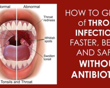 10 Effective Natural Home Remedies To Treat A Strep Throat Infection