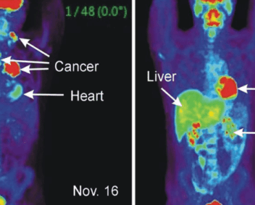 9 Warning Signs That Anounce Cancer May Be Growing in Your Body