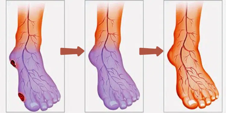 Cold Hands and Feet? This Could Be a Sign of Poor Circulation (And How ...